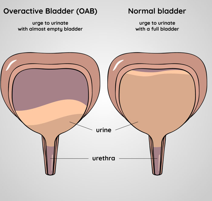 overactive bladder medication