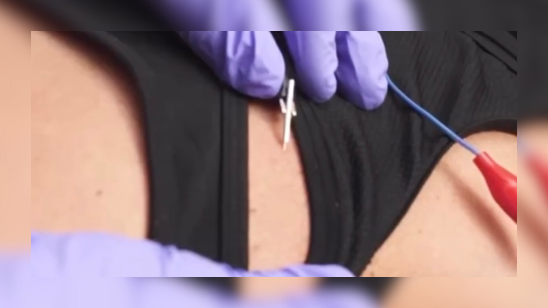A photo of dry needling