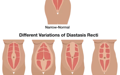 Diastasis Recti “Separating” Fact from Fiction