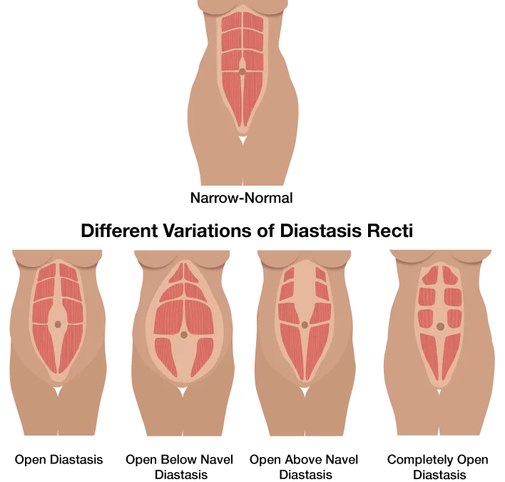 Diastasis Recti “Separating” Fact from Fiction