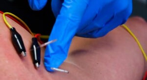 Dry Needling